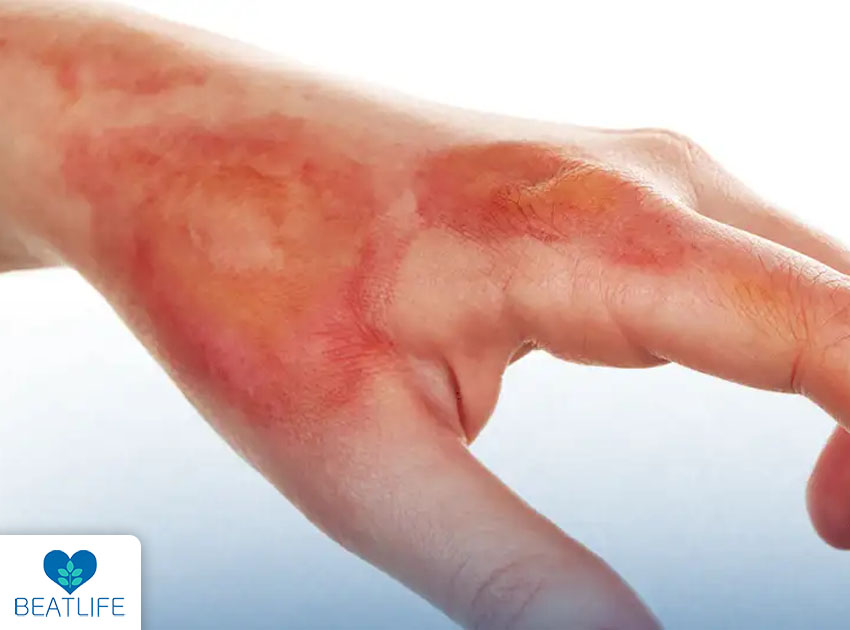 Understanding Difference Between 1st 2nd & 3rd Degree Burns in their Long-Term Effects